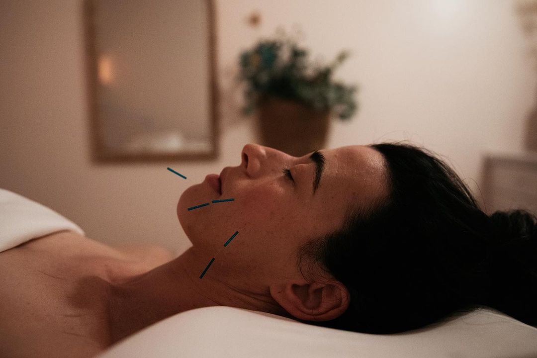 Cosmetic Acupuncture treatment at San Diego Spa Oh Glory in North Park featuring a woman with acupuncture needles in her face
