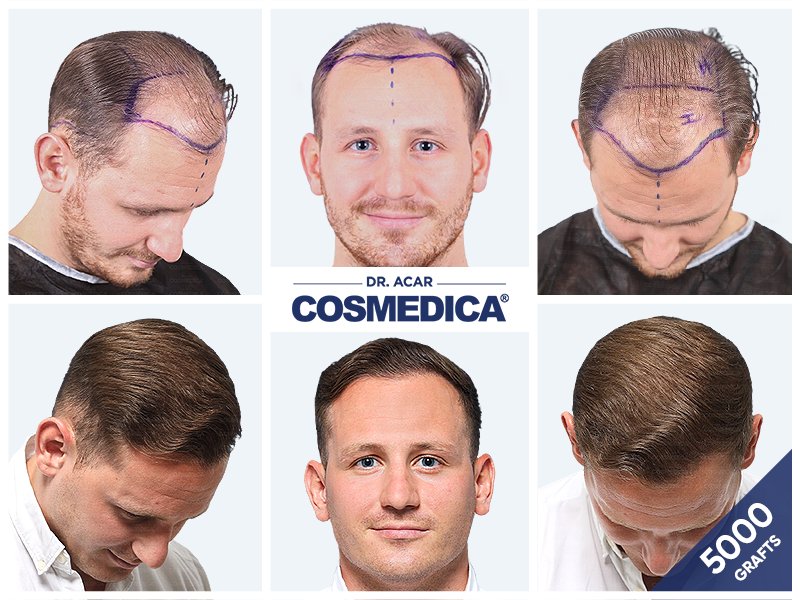 Before-after result of a 5,000 grafts hair transplant at the Cosmedica Clinic in Istanbul, Turkey